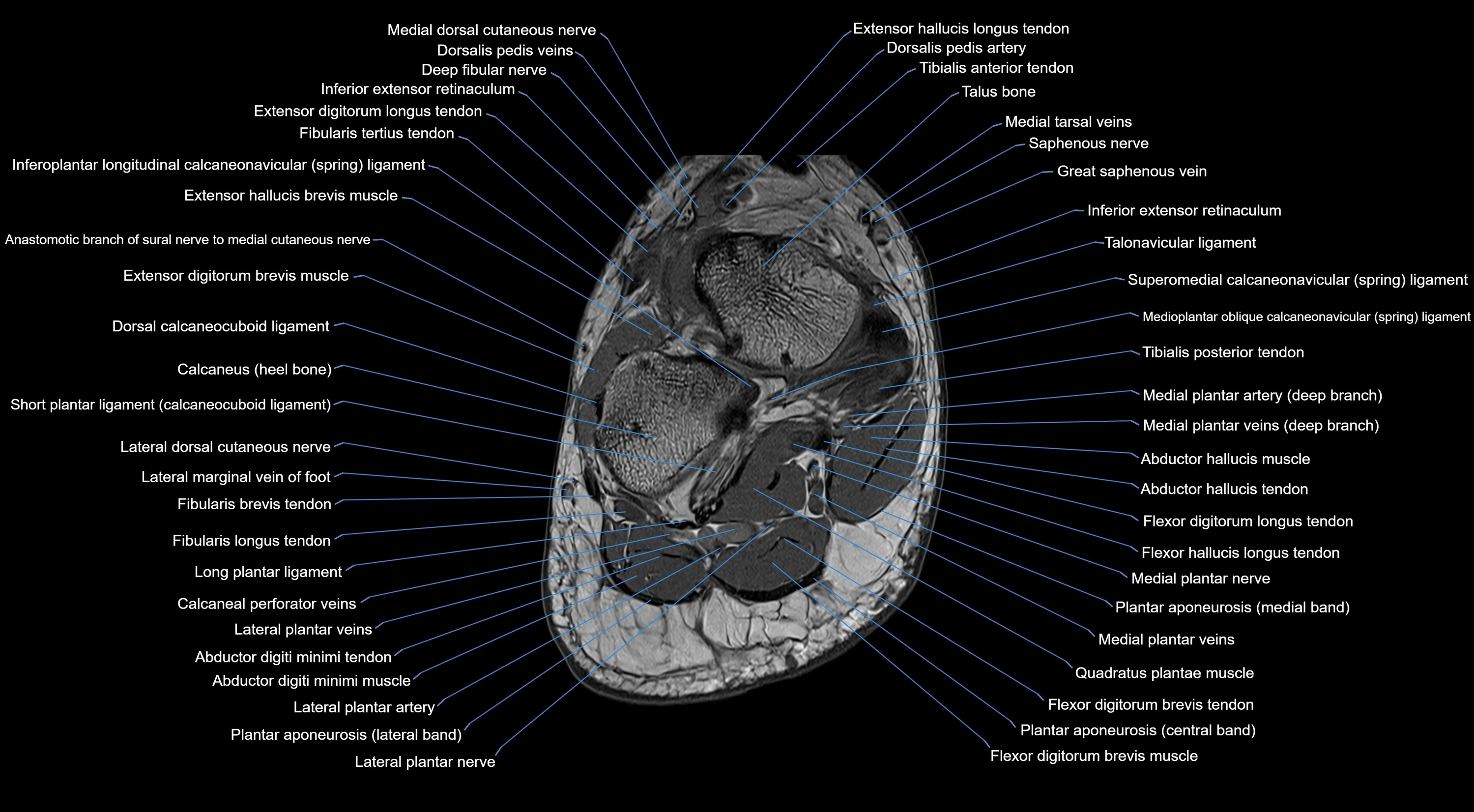 MRI mid foot coronal ligaments cross sectional anatomy 3T  radiology  image-img-00001-00037.webp